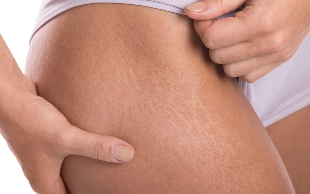 Cellulit kezelés: hogyan indulj el, ha simább bőrt szeretnél?